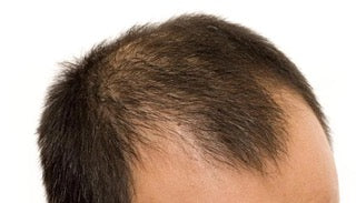 Demystifying Male Pattern Baldness: The Science Behind Hair Loss